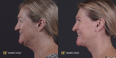 Eyelid Surgery before and after photo
