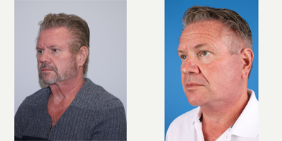 Facelift before and after photo