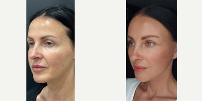 Facelift before and after photo