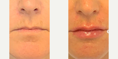 Lip Fillers before and after photo