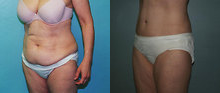 Liposuction before and after photo