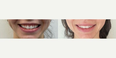 Botox for Gummy Smile before and after photo