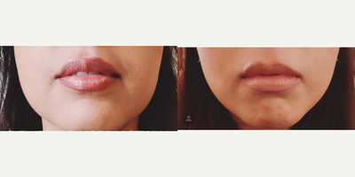 Botox before and after photo