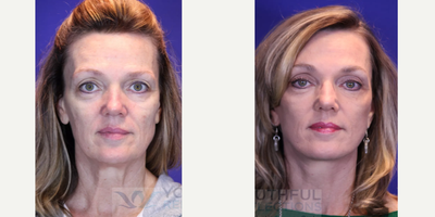 CO2 Laser before and after photo
