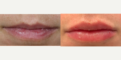 Lip Fillers before and after photo