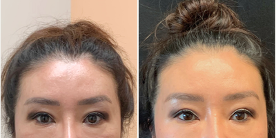 Thread Lift before and after photo