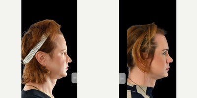 Transgender Facial Feminization Surgery before and after photo