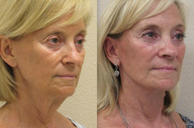Cheek Lift before and after photo