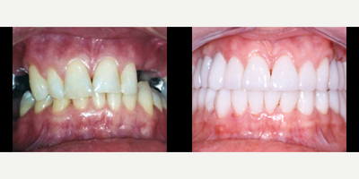 Dental Implants before and after photo