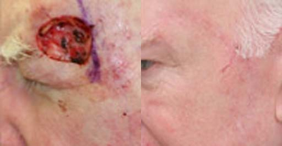 Facial Reconstructive Surgery before and after photo