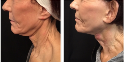 Microneedling before and after photo