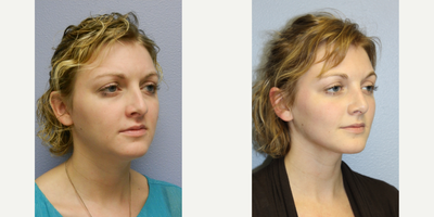 Rhinoplasty before and after photo