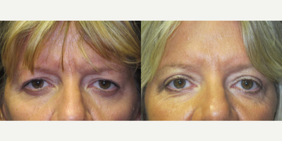 Eyelid Surgery before and after photo