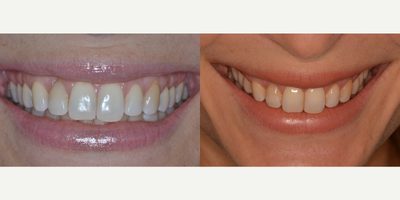 Gum Lift before and after photo