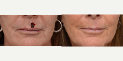 Mohs Surgery before and after photo