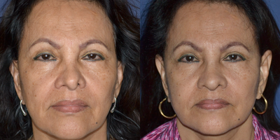 Revision Rhinoplasty before and after photo