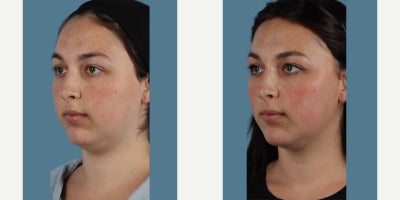 Chin Filler before and after photo
