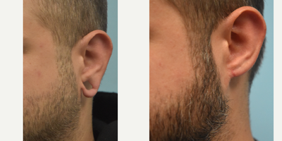 Earlobe Repair before and after photo