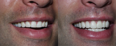 Porcelain Veneers before and after photo