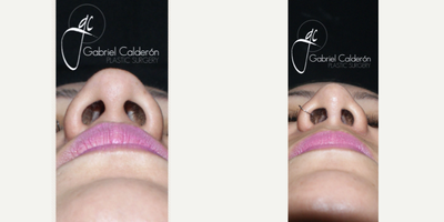Rhinoplasty before and after photo