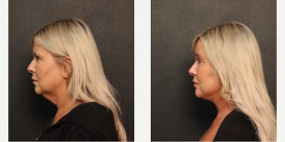 Brow Lift before and after photo