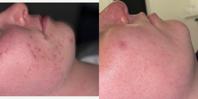 Chemical Peel before and after photo