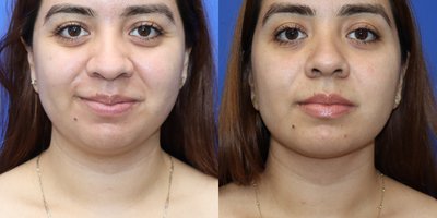 Chin Liposuction before and after photo