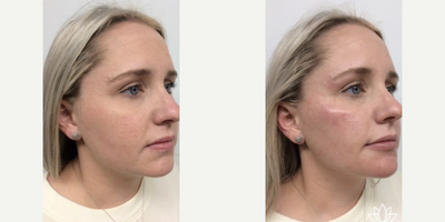 Dermal Fillers before and after photo