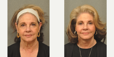 Facelift before and after photo