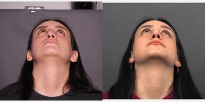 Revision Rhinoplasty before and after photo