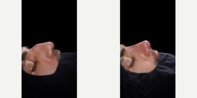 Revision Rhinoplasty before and after photo