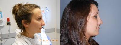 Rhinoplasty before and after photo