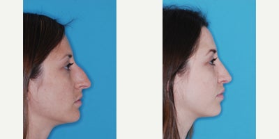 Rhinoplasty before and after photo