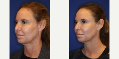 Ultherapy before and after photo