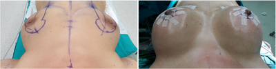 Breast Augmentation before and after photo