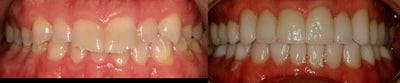 Dental Crown before and after photo
