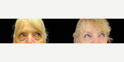 Eyelid Surgery before and after photo