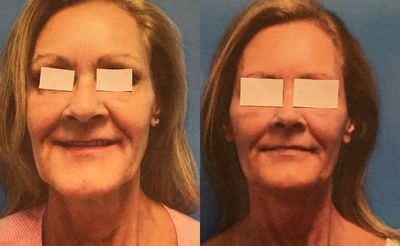 Microneedling RF before and after photo
