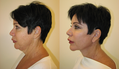 Neck Lift before and after photo