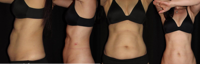 CoolSculpting before and after photo