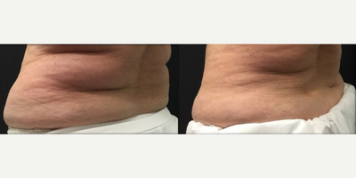 CoolSculpting before and after photo