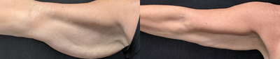 CoolSculpting before and after photo