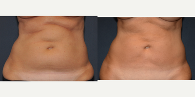 Liposuction before and after photo