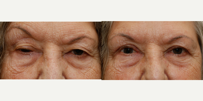Ptosis Surgery before and after photo