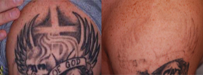 Restylane Defyne before and after photo