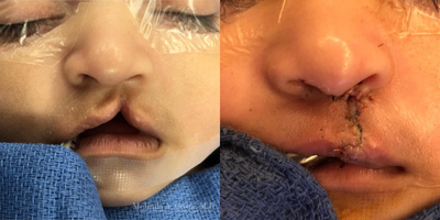 Cleft Lip And Palate Repair before and after photo