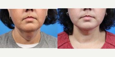 Facelift before and after photo