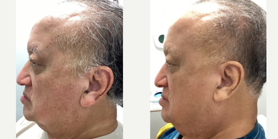 Laser Peel before and after photo