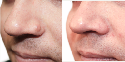 Rhinoplasty before and after photo