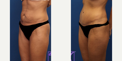 Tummy Tuck before and after photo